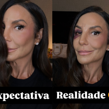 Ivete Sangalo mostra como ficou rosto após desmaio em retorno aos palcos nesta sexta-feira (27)