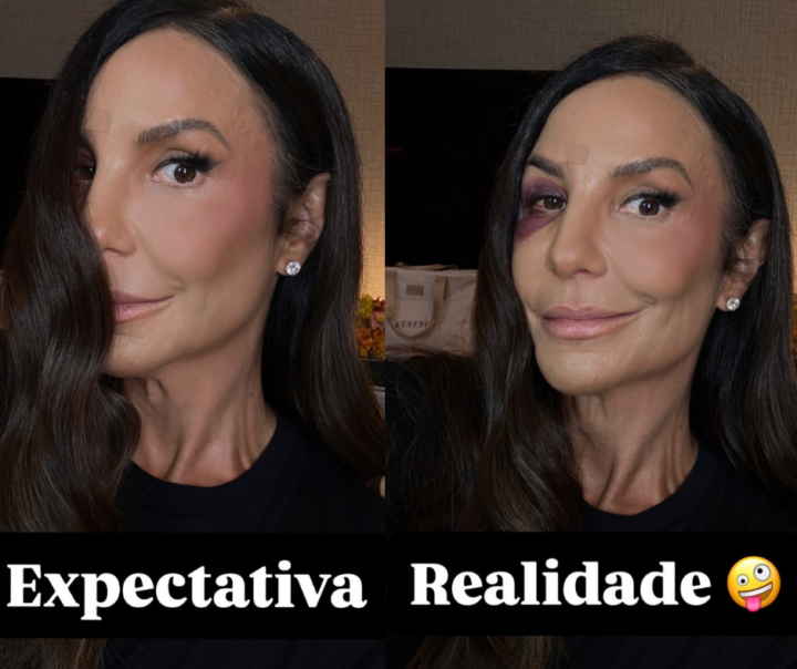 Ivete Sangalo mostra como ficou o rosto após desmaio em retorno aos palcos nesta sexta (27)