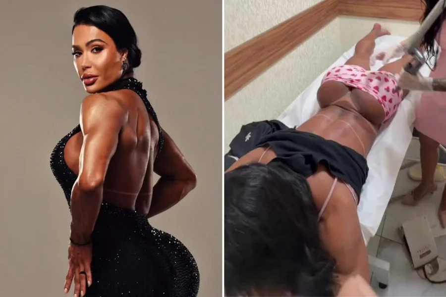 Gracyanne Barbosa inicia remoção da tatuagem íntima feita para Belo; veja vídeo