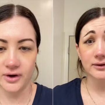 Erro em procedimento estético deixa americana com a expressão do filme ‘Pânico’
