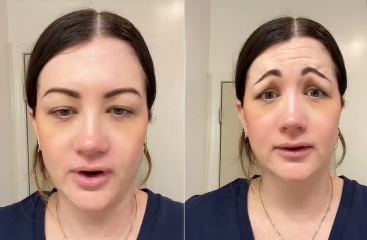Erro em procedimento estético deixa americana com a expressão do filme ‘Pânico’