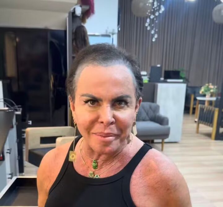 Em tratamento de alopecia, Gretchen aparece na web sem prótese capilar