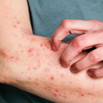 Bahia segue sem casos de Mpox em 2026, enquanto doença já atinge 13 estados do Brasil