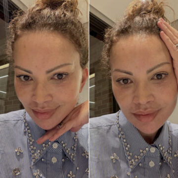 Solange Almeida mostra resultado após procedimentos estéticos no rosto: ‘Nunca foi vaidade’