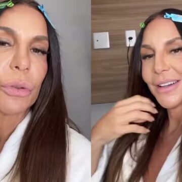 Uma semana após alta, Ivete Sangalo detalha lesão no rosto: ‘Colocaram duas presilhas de titânio’