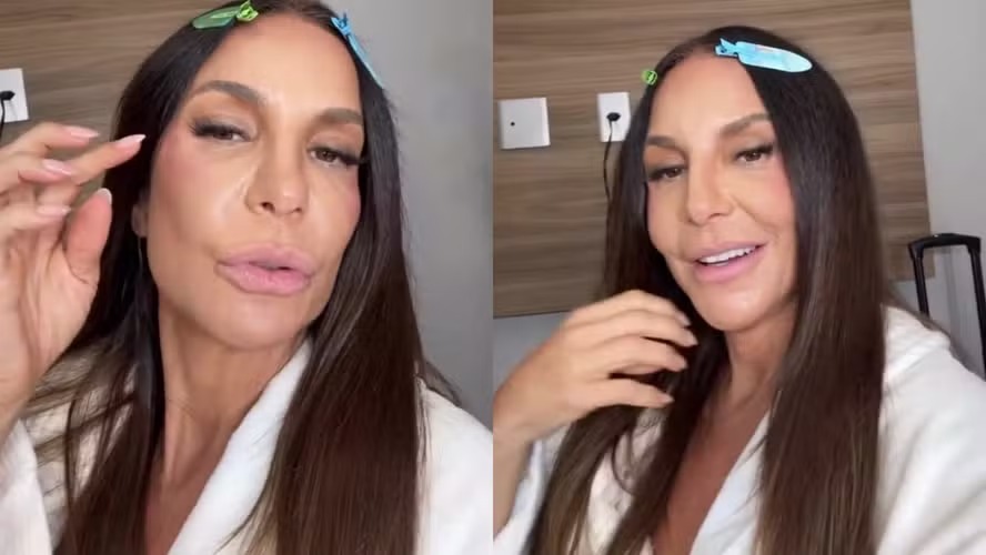 Uma semana após alta, Ivete Sangalo detalha lesão no rosto: ‘Colocaram duas presilhas de titânio’