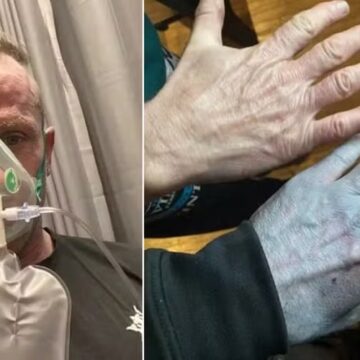 Homem acorda com corpo azulado, corre para hospital e diagnóstico surpreende: era tinta