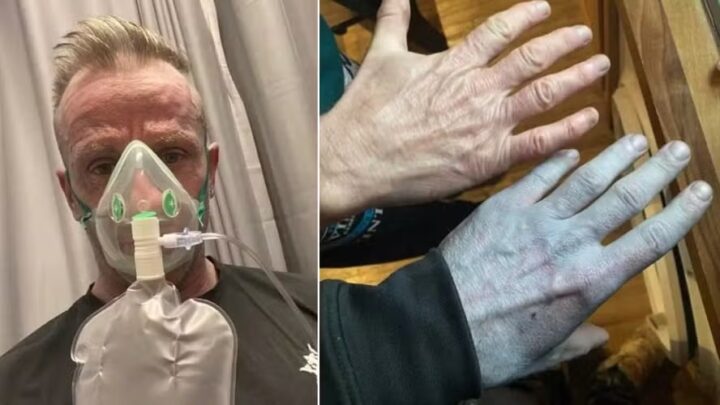 Homem acorda com corpo azulado, corre para hospital e diagnóstico surpreende: era tinta