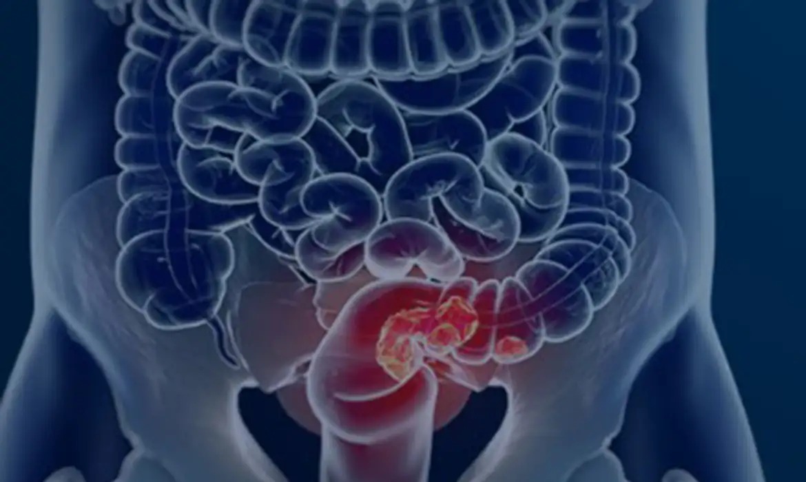 Rastreamento para câncer colorretal pode ser implementado no SUS