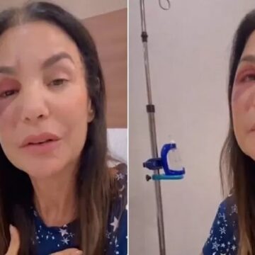 Ivete Sangalo mostra rosto após cirurgia: “Poderia ter sido muito pior”