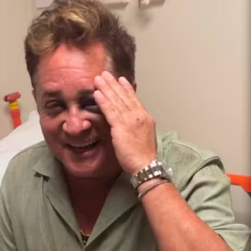 Leonardo aparece com olho roxo após queda e vai parar em hospital