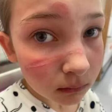 Mãe deixa pais em alerta após filha se queimar ao fazer trend de redes sociais
