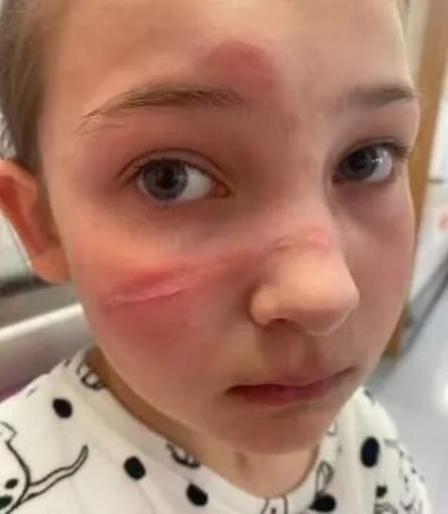 Mãe deixa pais em alerta após filha se queimar ao fazer trend de redes sociais