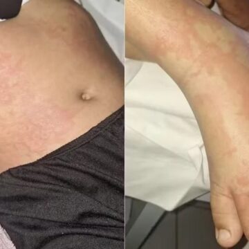 Menina de 10 anos é internada com infecção após contato com detergente Ypê