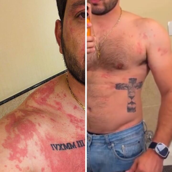Ex-BBB vai parar no hospital após relatar crise alérgica “assustadora”
