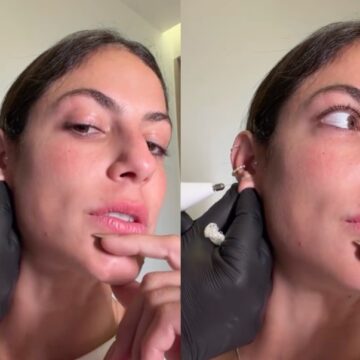 Mari Gonzalez passa por procedimento na orelha e exibe resultado: ‘Estou chocada’
