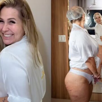 Ex-Paquita Andréa Sorvetão perde 20kg e passa por tratamento para celulite