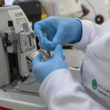 Ministério da Saúde inclui nova terapia para leucemia mieloide aguda no SUS