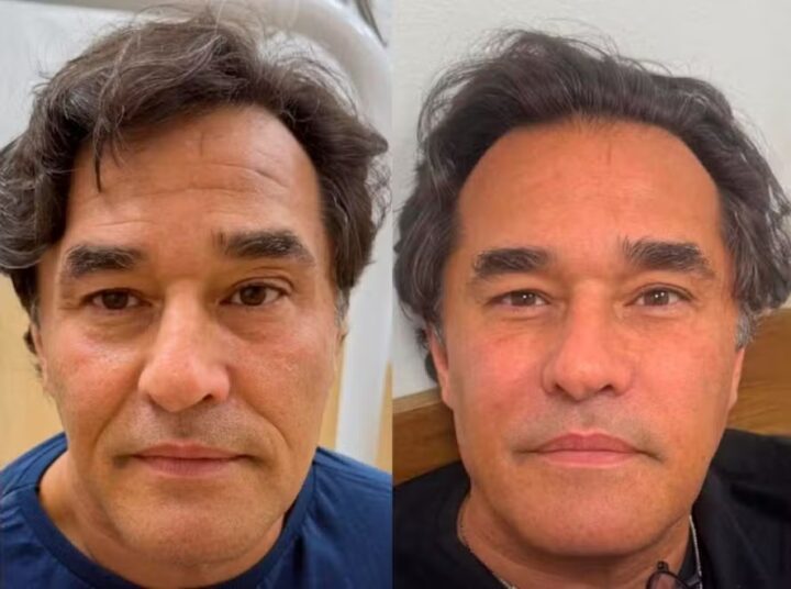 Pai de Sasha, Luciano Szafir faz harmonização facial pela primeira vez: ‘Não gosto de nada em excesso’