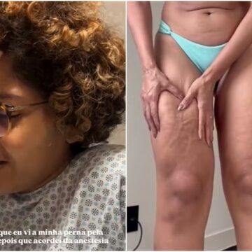 Barbara Reis mostra antes e depois da perna após cirurgia: ‘Só sabia chorar’