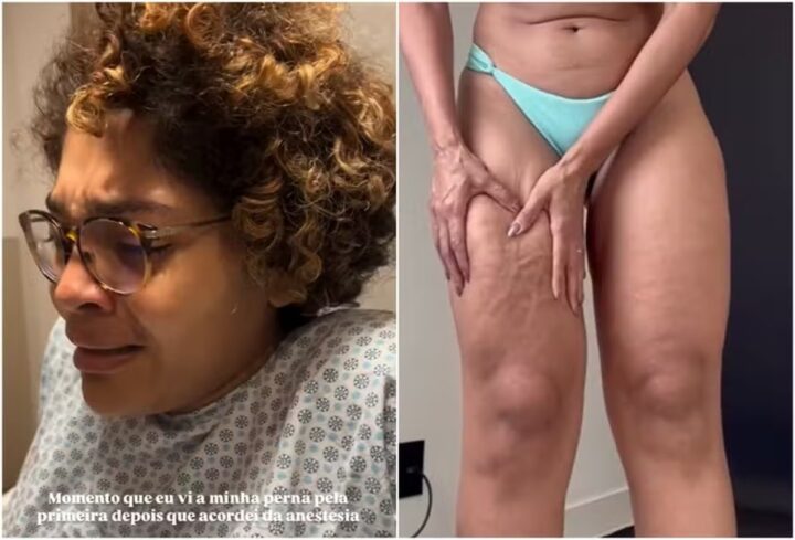 Barbara Reis mostra antes e depois da perna após cirurgia: ‘Só sabia chorar’