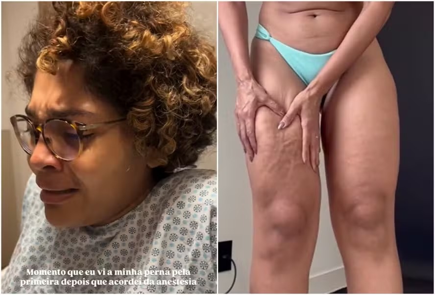 Barbara Reis mostra antes e depois da perna após cirurgia: ‘Só sabia chorar’