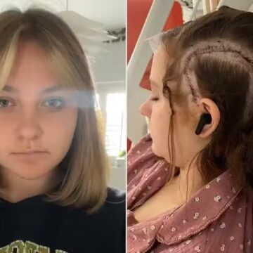 Adolescente se torna paciente mais jovem a passar por cirurgia cerebral acordada