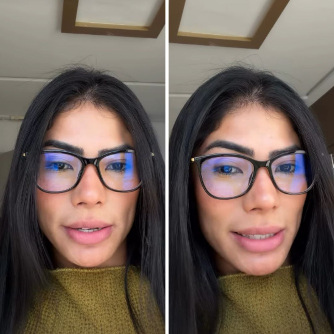 Ex-BBB Marciele revela diagnóstico de alopecia e fala de tratamento: ‘Não tá caindo’