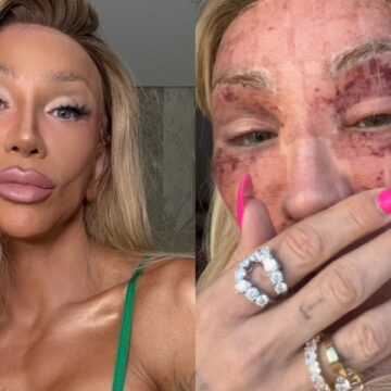 Maya Massafera atualiza estado de saúde e choca ao mostrar rosto: ‘Não consigo rir’