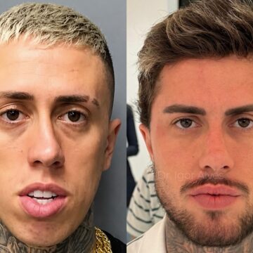 Quantos procedimentos MC Daniel fez? Funkeiro surge irreconhecível após transformação