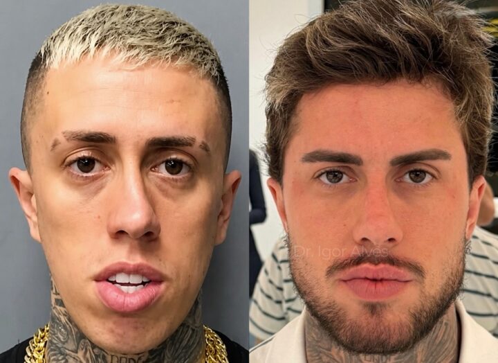 Quantos procedimentos MC Daniel fez? Funkeiro surge irreconhecível após transformação