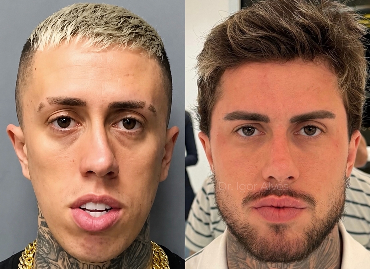 Quantos procedimentos MC Daniel fez? Funkeiro surge irreconhecível após transformação