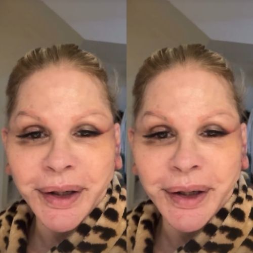 Monique Evans faz cirurgia no rosto e passa por situação inusitada com reconhecimento facial do banco