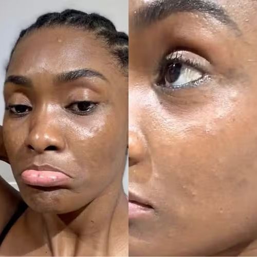 Erika Januza revela reação alérgica após comer peixe com gordura de camarão: ‘Rosto todo empolado’