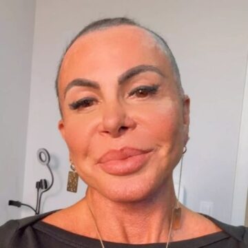 Gretchen atualiza recuperação após transplante capilar e tranquiliza fãs: ‘Olha como estou bem’