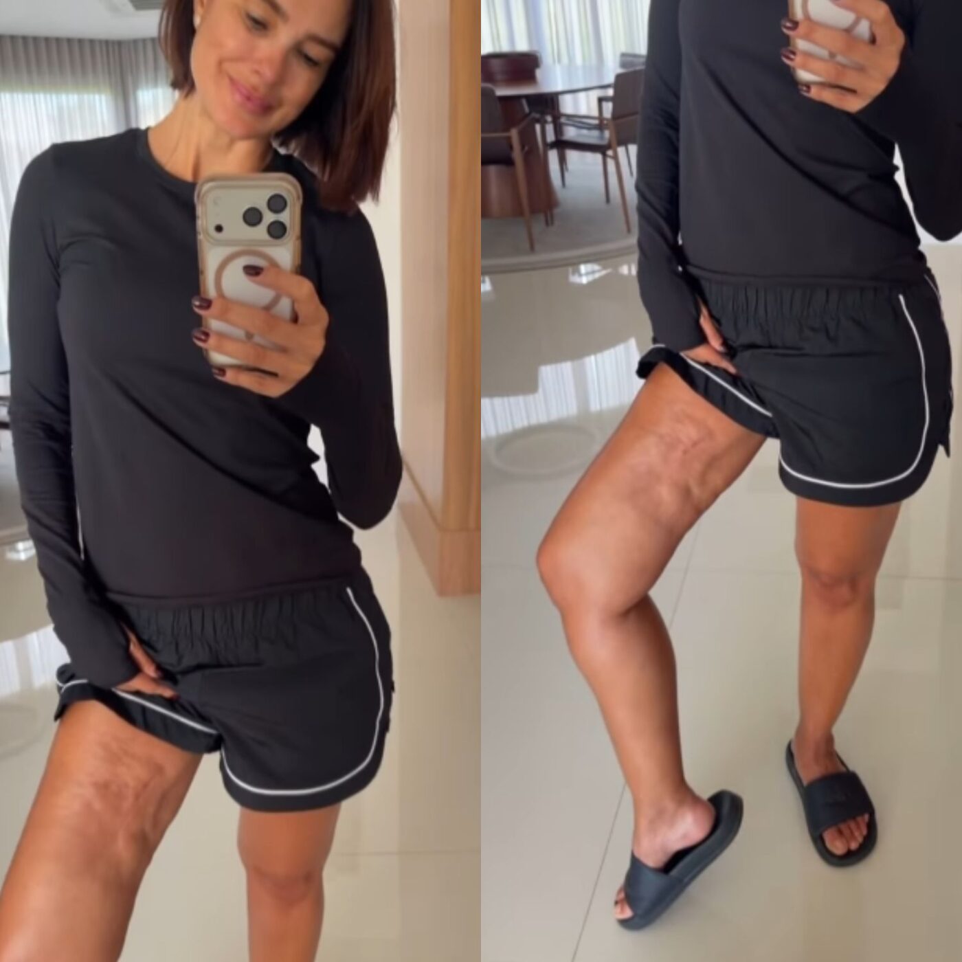 Vera Viel mostra cicatriz após retirada de tumor agressivo: ‘Não posso ter vergonha’