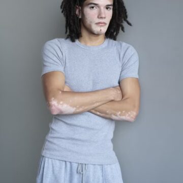 Conheça jovem com vitiligo que estreia como modelo e quer ampliar referências de beleza