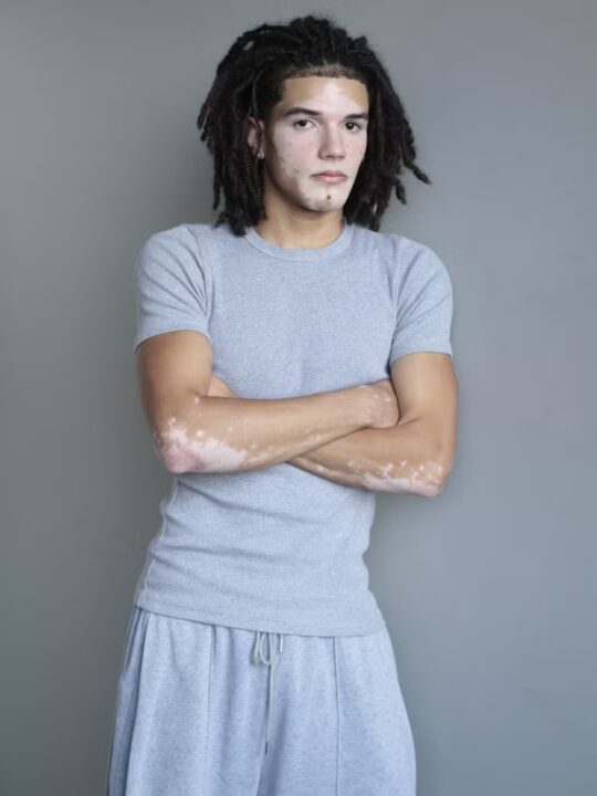 Conheça jovem com vitiligo que estreia como modelo e quer ampliar referências de beleza