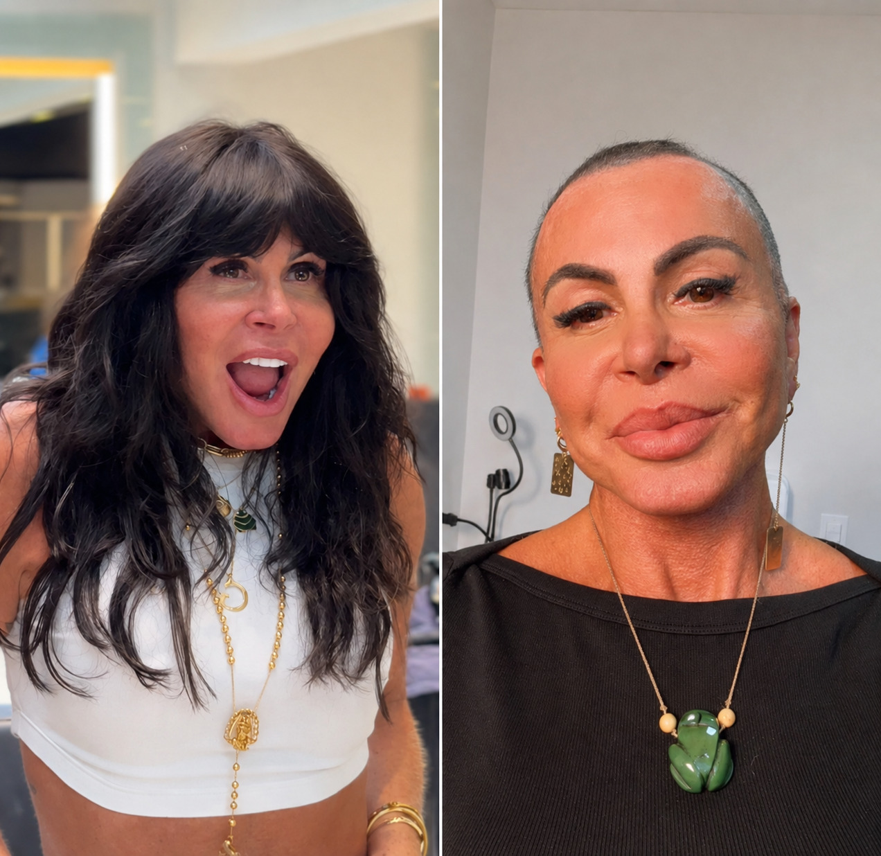 Aos 67 anos, Gretchen raspa a cabeça antes de transplante capilar e revela luta contra alopecia agressiva