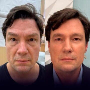 Aos 56 anos, ator que fez o Cigano Igor faz aparição após harmonização facial