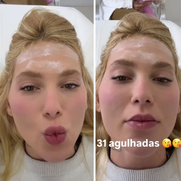 Virginia Fonseca faz tratamento contra enxaqueca e revela 31 agulhadas na cabeça