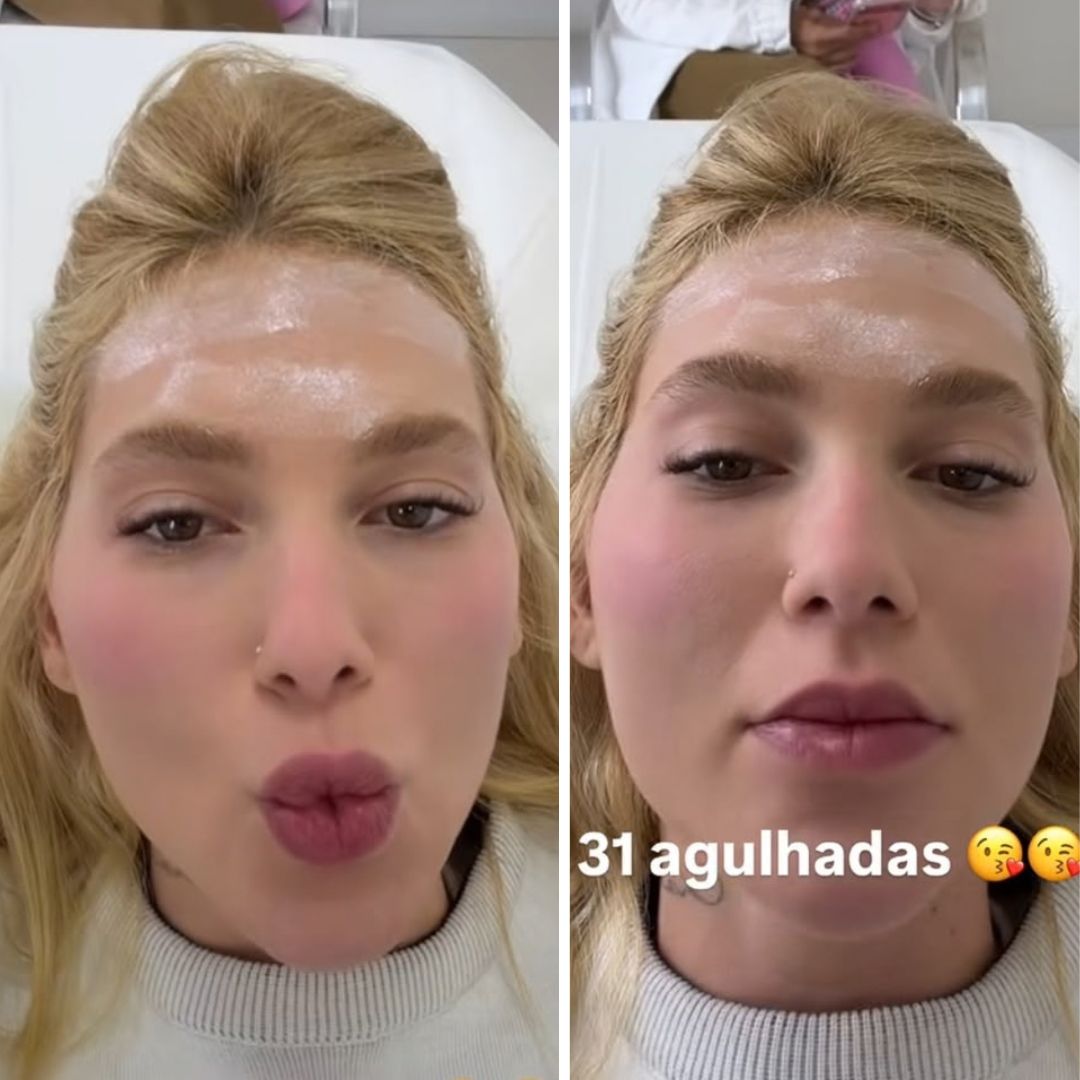 Virginia Fonseca faz tratamento contra enxaqueca e revela 31 agulhadas na cabeça