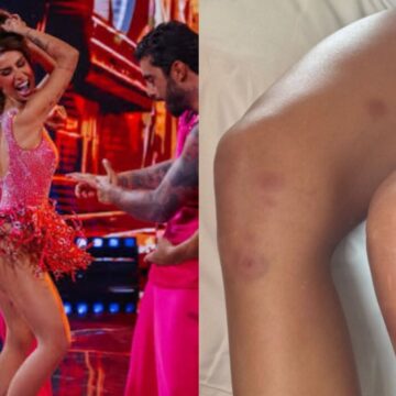 Bianca Andrade exibe hematomas após rotina intensa de ensaios na ‘Dança dos Famosos’: ‘É desesperador’