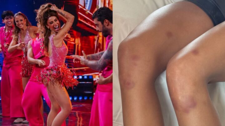 Bianca Andrade exibe hematomas após rotina intensa de ensaios na ‘Dança dos Famosos’: ‘É desesperador’