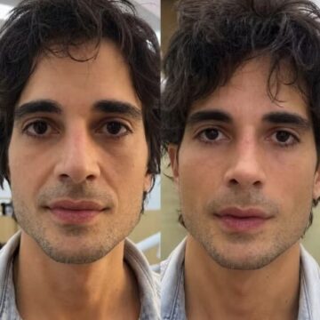 Fiuk exibe resultado de harmonização facial ao vivo; confira antes e depois