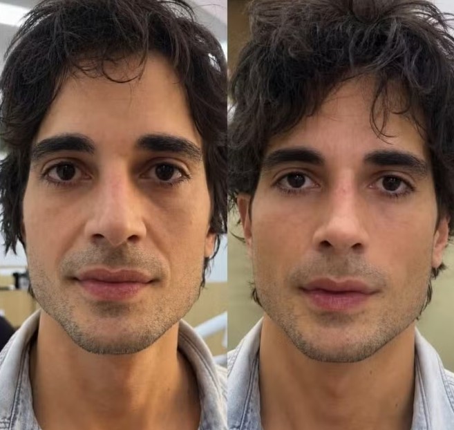 Fiuk exibe resultado de harmonização facial ao vivo; confira antes e depois