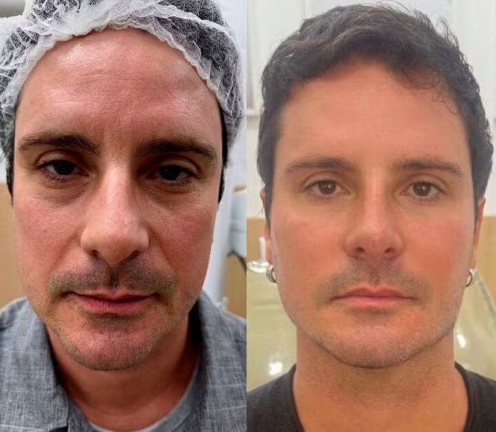 Aos 51 anos, ex-galã de Malhação reaparece após fazer harmonização facial