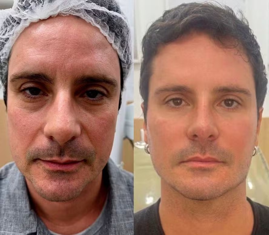 Aos 51 anos, ex-galã de Malhação reaparece após fazer harmonização facial