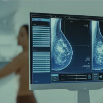 Governo obriga plano de saúde a cobrir exame de mamografia digital para todas as idades