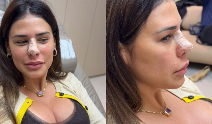 Aos 42 anos, Simone Mendes surge com curativo no nariz após procedimento estético e detalha recuperação